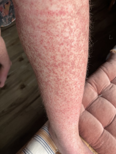 Henoch Schonlein Purpura (HSP for short) - anyone have any experience of this very random autoimmune illness?
