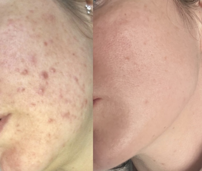 Adult acne - so annoying!