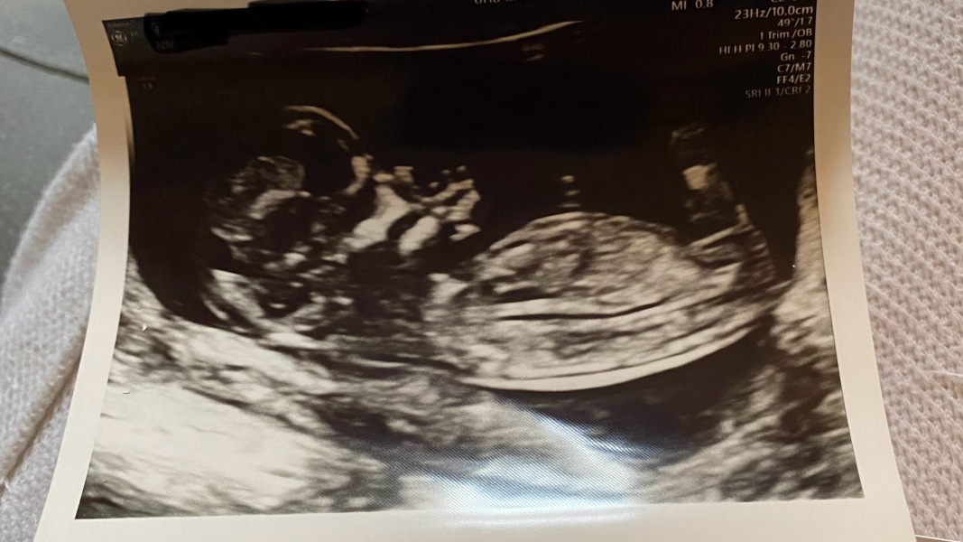 Nub theory please! 13 week scan