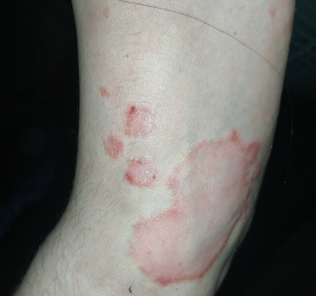Doctors not agreeing on cause of rash (photo uploaded)
