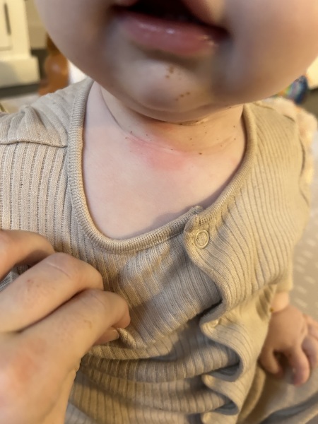 Baby allergic to Alpro oat milk, but not oat yoghurt?