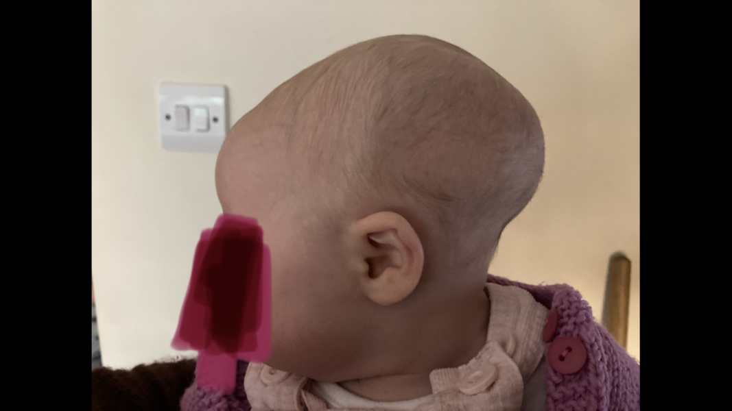 Craniosynostosis or am I over worrying?