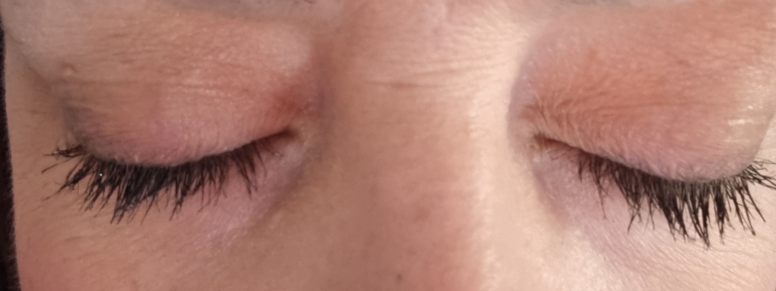 My eyelids are aging