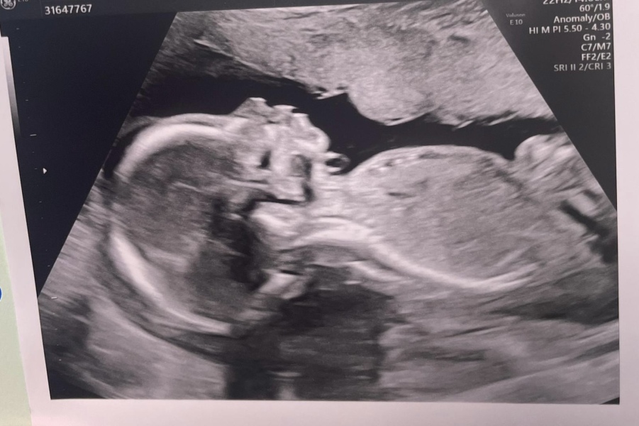 Come predict baby’s gender 20 wk scan