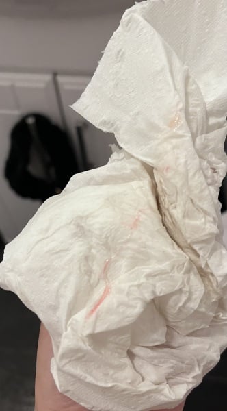 IMPLANTATION BLEEDING - with photo