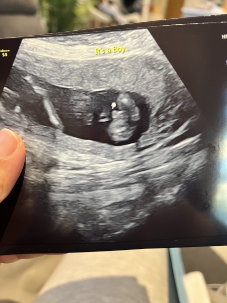 Ultrasound boy or cord?