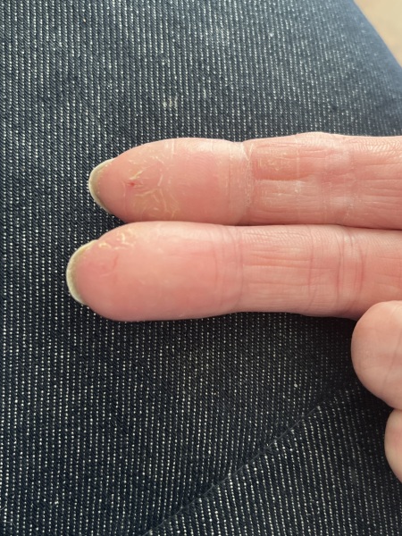 Hand eczema/pompholyx . Help! Trying to wean off steroid but keep reflaring!