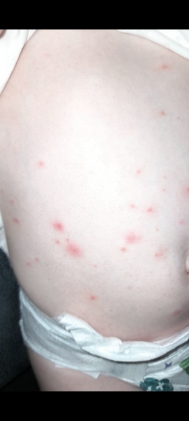 Is this chicken pox and does it always itch