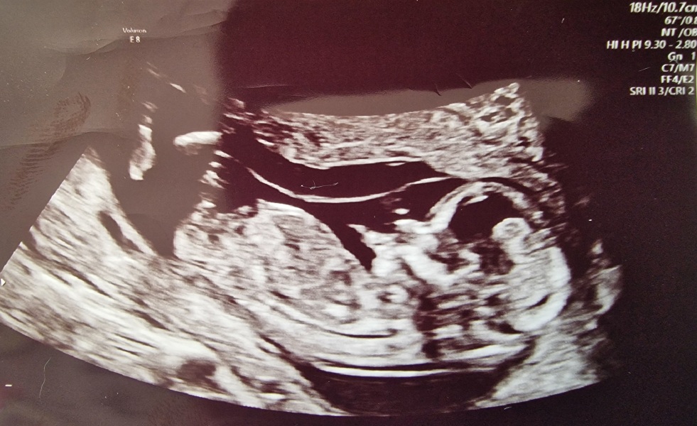 IBS flare up and miscarriage link?