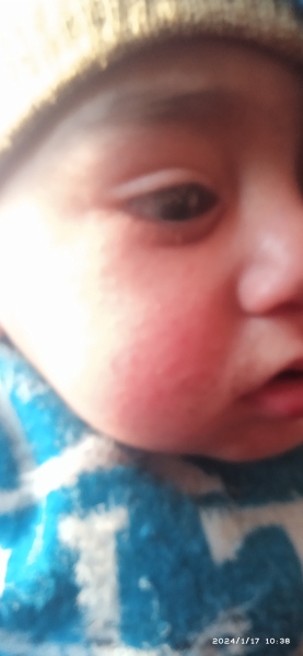 Baby face rash
