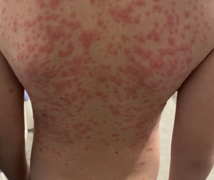 Chicken pox .. is this normal