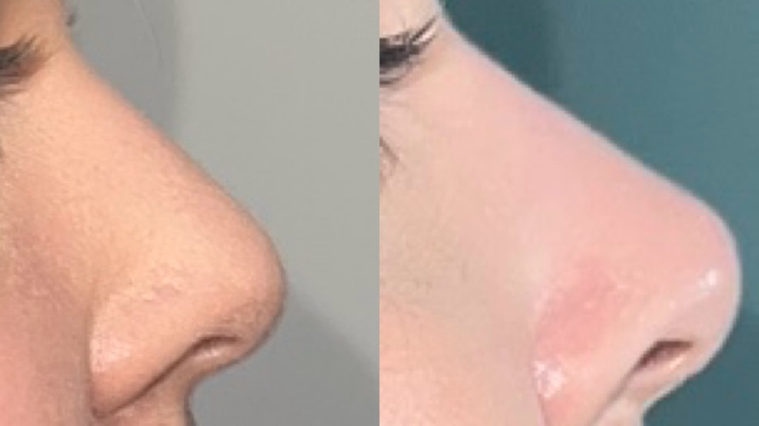 Non-surgical rhinoplasty