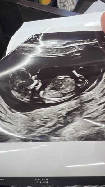 nub/skull  for 12weeks scan guess boy or girl