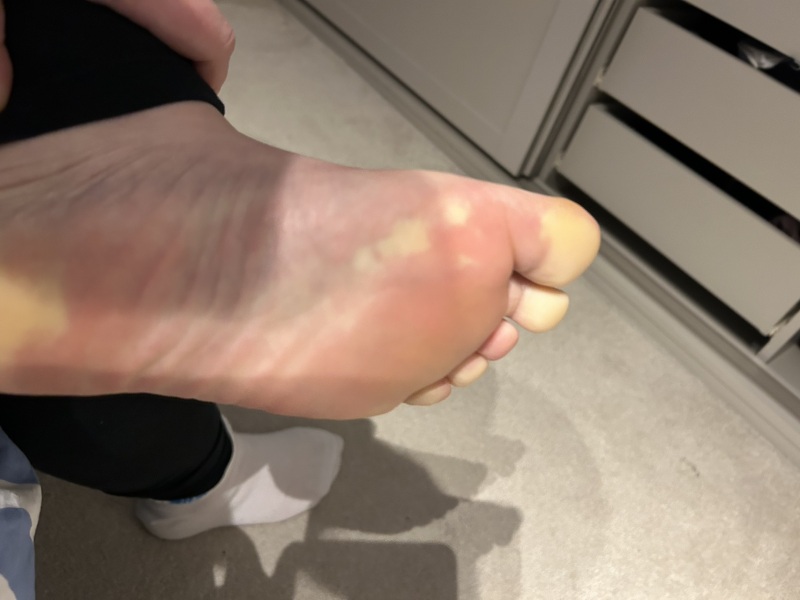 Is this Raynaulds disease? Foot Pic TW!