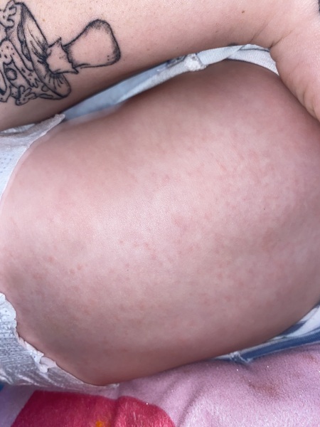 Any guesses as to what this rash is...??