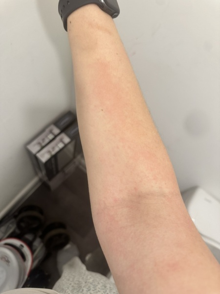 Rash