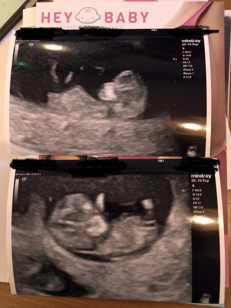 Twins due 2024