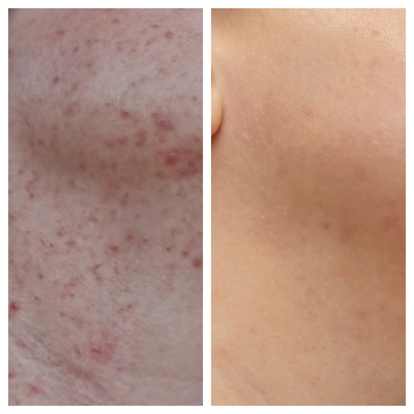 Adult acne - so annoying!