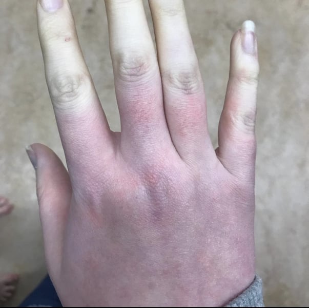 Is this Raynaulds disease? Foot Pic TW!