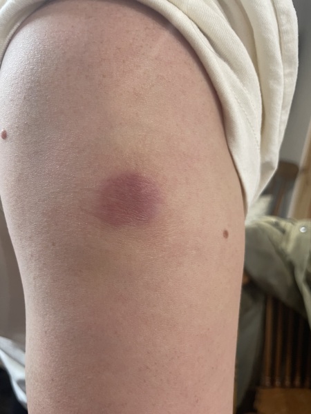 Biopsy on skin.