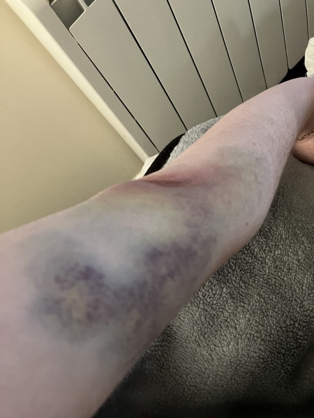 Bruises