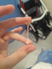 Mucus plug TMI PIC