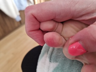 Sore red patched on toes ? Anyone any clued