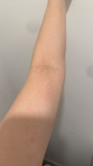 Potential Eczema?