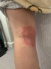 Rash on leg