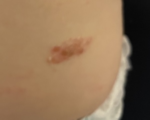 Does this look/sound like eczema?