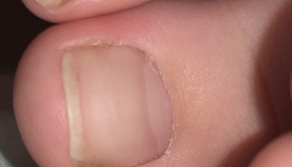 Ingrown toe nail?