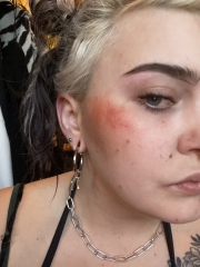 Is this an autoimmune issue
