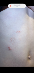Can anyone identify this rash?