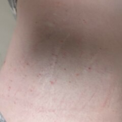 Could this be scabies?