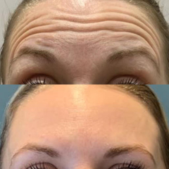 Botox is it worth it?