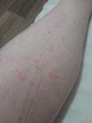 Rash/hives