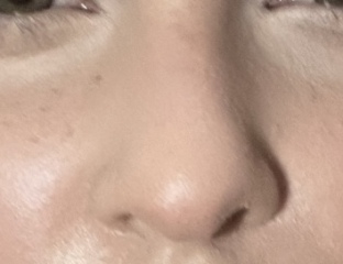 Non-surgical rhinoplasty