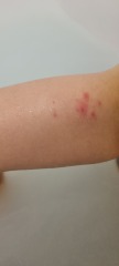 Rash - chicken pox or something else?