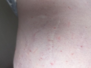 Could this be scabies?