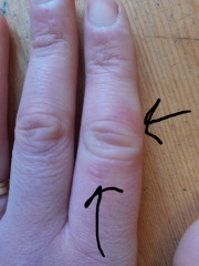 Chilblain (finger) or something else