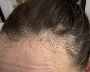 Thinning hair