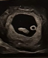 Extra chorionic Hematoma