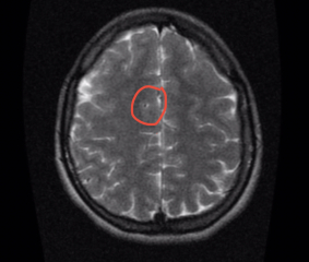 anyone know this?Brain MRI question?
