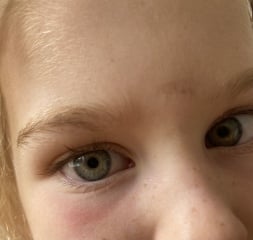 Red skin below dd's eyes