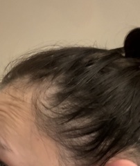 Thinning hair