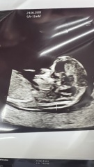 nub/skull  for 12weeks scan guess boy or girl