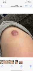 Skin biopsy