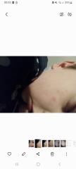 Could this be scabies!?