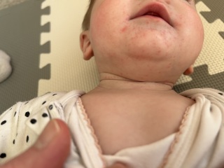 Baby potential egg allergy