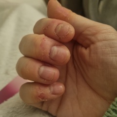 Skin picking (pics included)